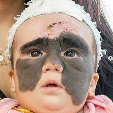 "Betman maska"lı amerikalı uşaq Rusiyada əməliyyat olunduqdan sonra - FOTO-VİDEO