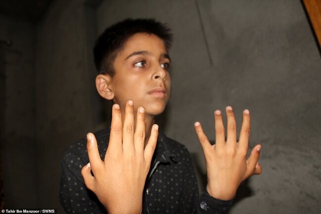 Bu oğlanın hər əlində 6 barmaq var - Bunun sayəsində o.... - FOTO-VİDEO