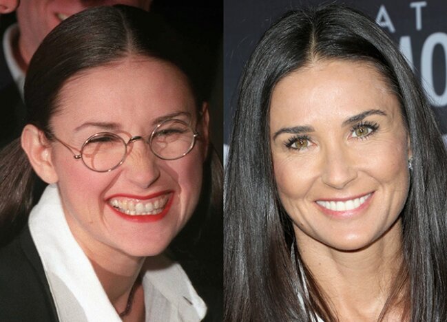 Dişlərini düzəltdirib BELƏ OLDULAR - FOTOLAR