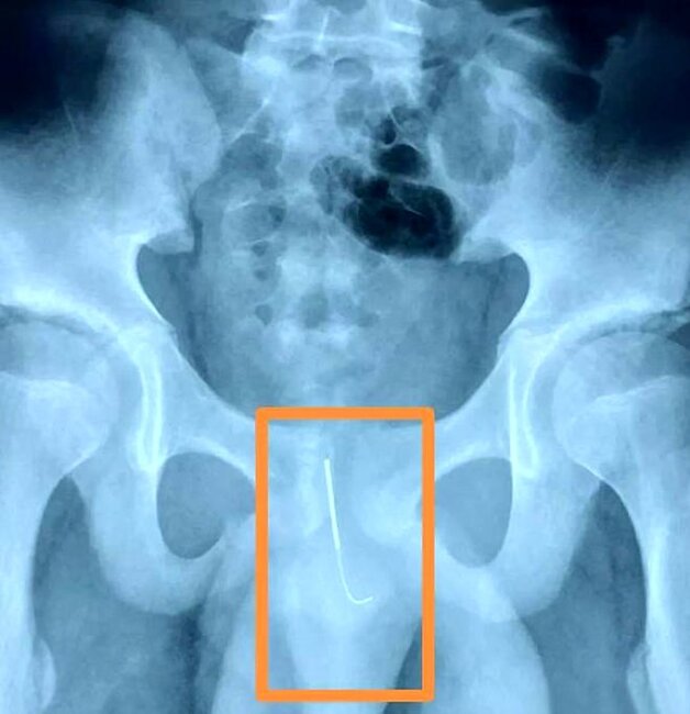 12 yaşlı uşağın gecə dərs etmək istədiyi üçün etdiyi hərəkət ŞOK ETDİ- cinsiyyət orqanına.. - FOTO