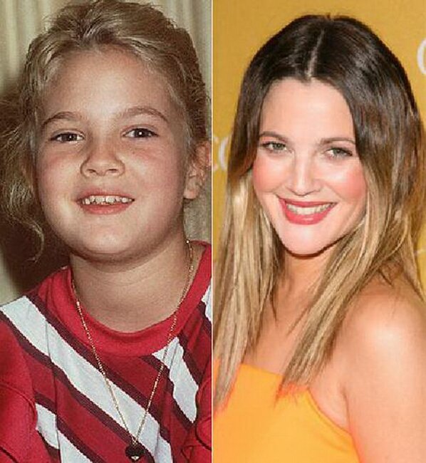 Dişlərini düzəltdirib BELƏ OLDULAR - FOTOLAR