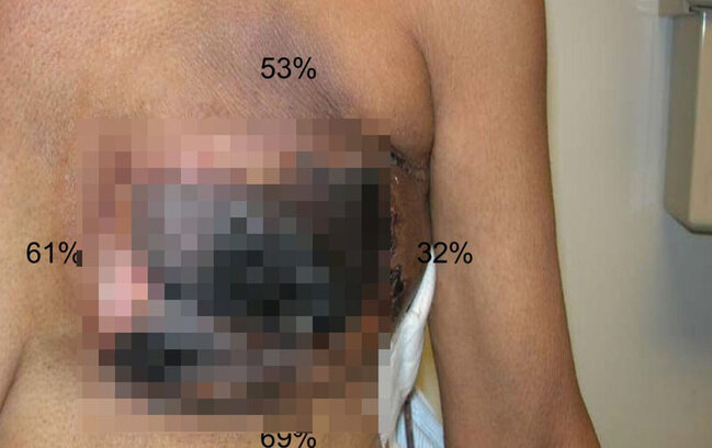 Əməkdar artistin əməliyyatdan sonra bədəni çürüyür?