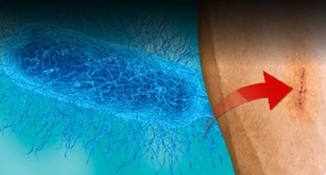 Ət yeyən bakteriya can alır, yoluxma halları artır