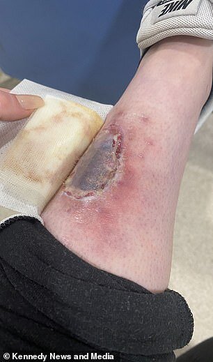 3 ay solariuma getdi, ayağındakı kiçik xal BU HALA DÜŞDÜ - DƏHŞƏTLİ FOTOLAR