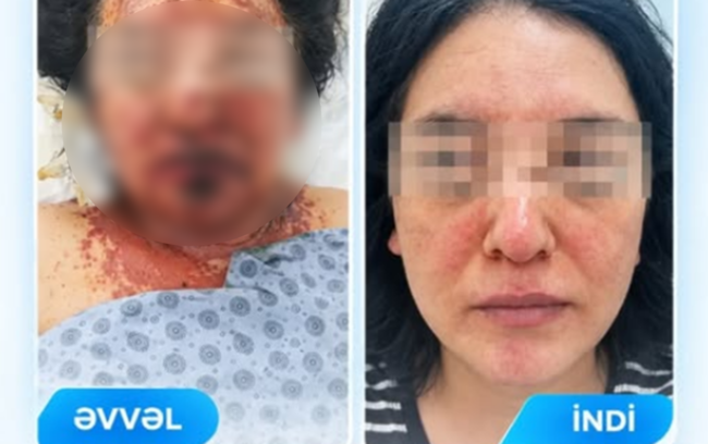 Dərman qəbulundan sonra ağır allergik reaksiya verdi