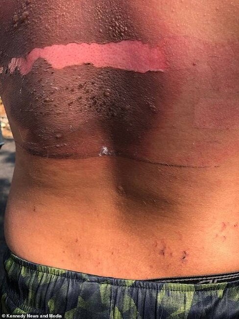 Telefonu şarja qoyub yuxuya gedən yeniyetmə BELƏ YANDI - FOTO+18