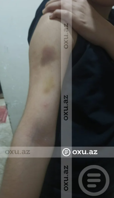 Bakıda məktəbli sinif yoldaşı tərəfindən döyüldü: Kamera niyə işləməyib? - İDDİA - FOTO