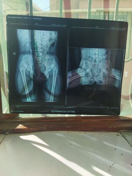 Yeddi yaşlı Aytən təcili əməliyyat olunmalıdır - FOTO