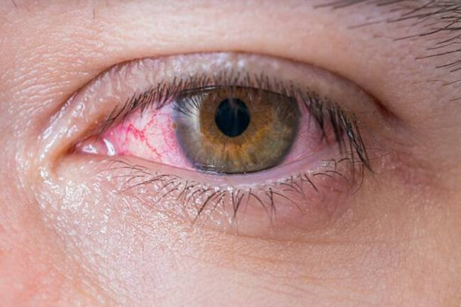 Koronavirus gözə necə təsir edir?