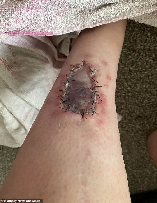 3 ay solariuma getdi, ayağındakı kiçik xal BU HALA DÜŞDÜ - DƏHŞƏTLİ FOTOLAR