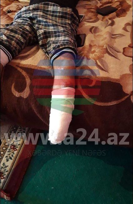 Tərtərdə mi̇naya düşüb bir ayağını itirən 22 yaşlı Azadın FOTOLARI