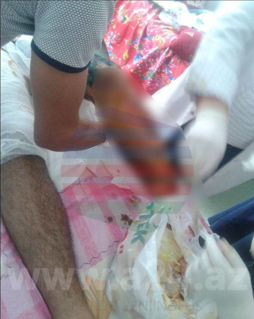 Tərtərdə mi̇naya düşüb bir ayağını itirən 22 yaşlı Azadın FOTOLARI