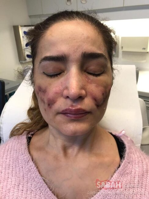 Plastik əməliyyat edən qadın tanınmaz hala düşdü - DƏHŞƏTLİ FOTOLAR