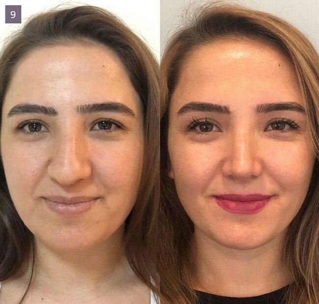 BURUN insan üzünü BELƏ DƏYİŞİR - FOTOLAR