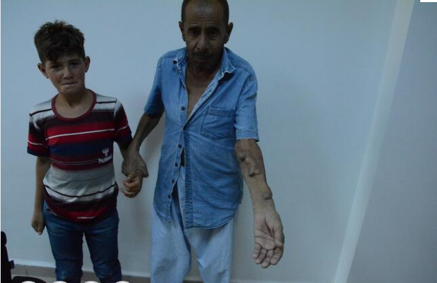 Bu kişi nadir xəstəliklərdən birinə tutuldu: qolları öz-özündən şişir