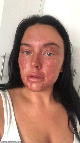"TikTok"dakı üsulla yumurta bişirməyə çalışan qadının bütün üzü yandı - FOTO/VİDEO
