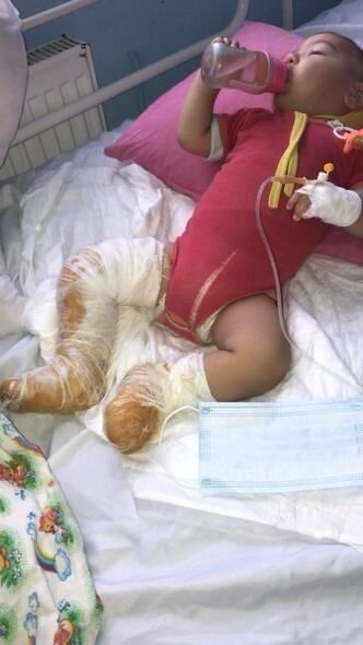 11 aylıq körpənin üstünə qaynar çaydan aşıb: Yardıma ehtiyacı var - FOTO