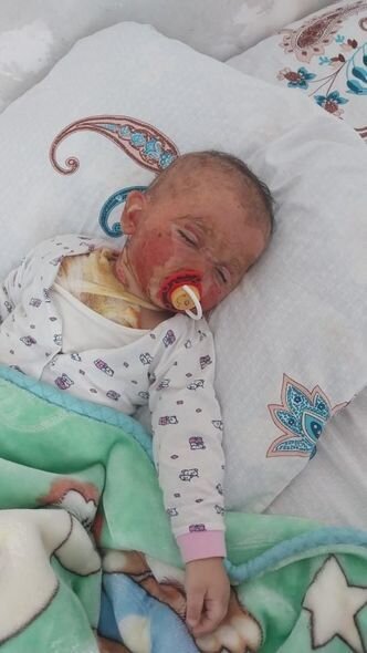 İki yaşlı körpənin başından qaynar su tökülüb: Müalicəsinə 500 manat pul tapmırlar - FOTO