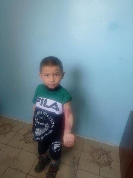 Üzərinə qaynar su tökülən altı yaşlı Ayxanın anası: "Bütün yayı qış ayaqqabıları ilə keçirdi" - FOTO/VİDEO