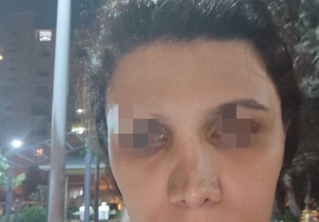 Artromed klinikasında təhlükəli burun əməliyyatı – Vətəndaş prokurorluğa müraciət etdi – VİDEO