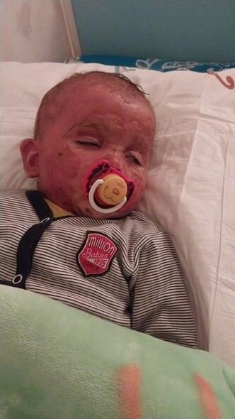 İki yaşlı körpənin başından qaynar su tökülüb: Müalicəsinə 500 manat pul tapmırlar - FOTO