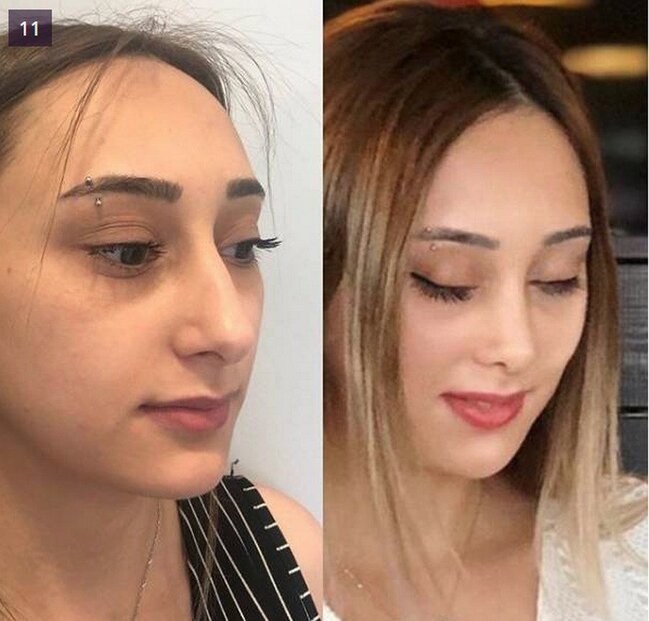 BURUN insan üzünü BELƏ DƏYİŞİR - FOTOLAR