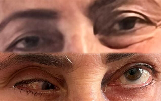 Bu klinika təzminat ödəyəcək - Burun düzəldəndə gözü zədələyib