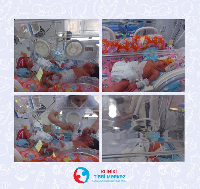 Bakıda koronavirus xəstələri üçəm və dördəm dünyaya gətiriblər - FOTO