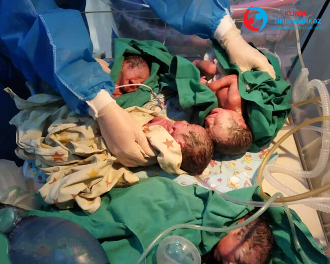 Bakıda koronavirus xəstələri üçəm və dördəm dünyaya gətiriblər - FOTO