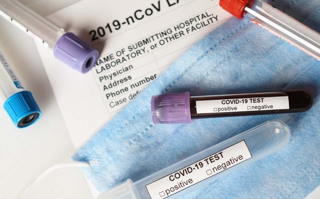 Türkiyədə daha 2 102 nəfər koronavirusa yoluxdu