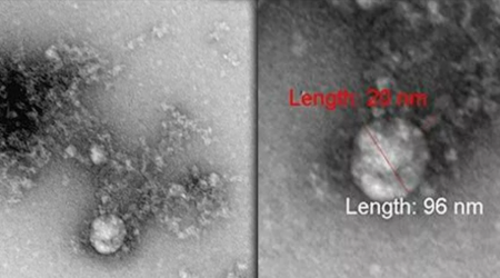 Uşaqlarda bu əlamətlər varsa, demək... - Koronavirusun yeni növü, yoxsa sindrom?