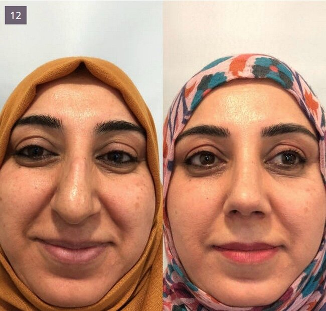 BURUN insan üzünü BELƏ DƏYİŞİR - FOTOLAR