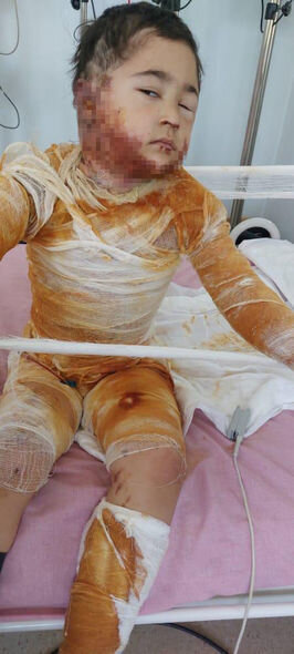 6 yaşlı Zeynəbin saçına düşən alov bütün bədənini yandırıb: Əməliyyatı üçün 600 manat əskik qalıb - FOTO