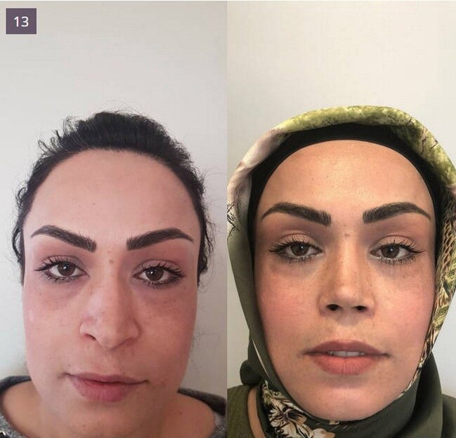 BURUN insan üzünü BELƏ DƏYİŞİR - FOTOLAR