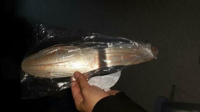 Cərrah malanı xəstənin qarnında unutdu - Qalmaqal - FOTO