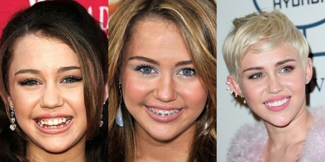 Dişlərini düzəltdirib BELƏ OLDULAR - FOTOLAR