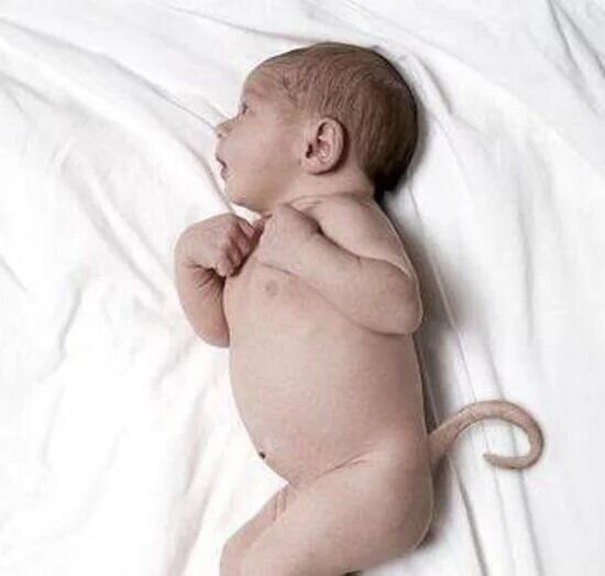 12 sm quyruqla doğulan körpə əməliyyat edildi - FOTO