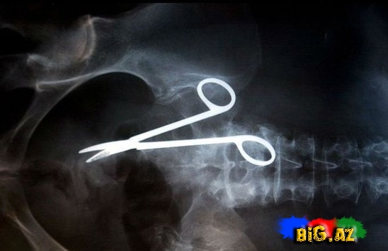 Mədəsində 10 il qayçı gəzdirdi