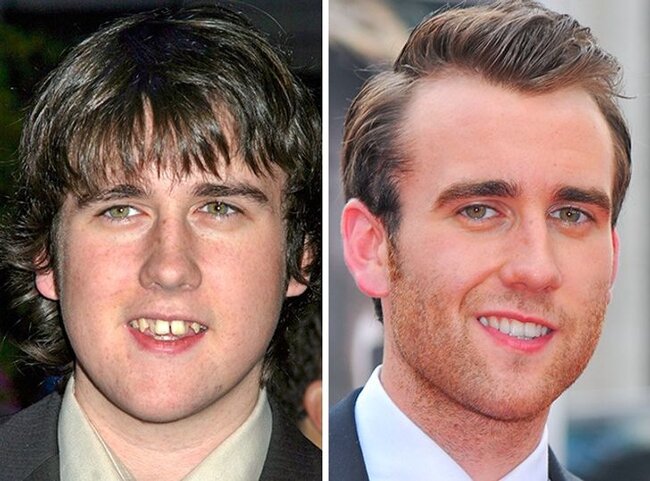 Dişlərini düzəltdirib BELƏ OLDULAR - FOTOLAR