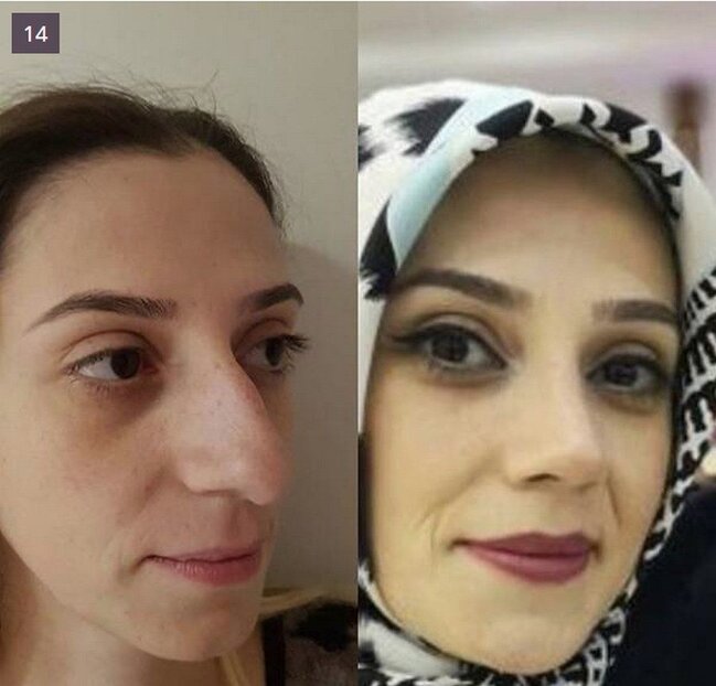 BURUN insan üzünü BELƏ DƏYİŞİR - FOTOLAR
