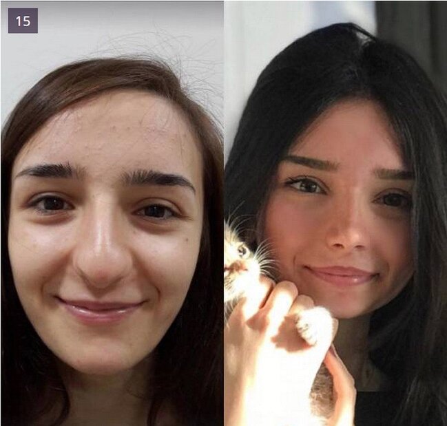 BURUN insan üzünü BELƏ DƏYİŞİR - FOTOLAR