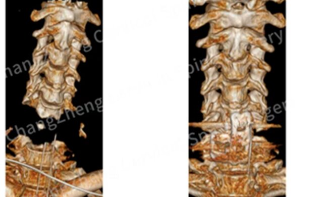 Şanxayda nadir əməliyyat - Qopmuş başını yerinə bərpa etdilər