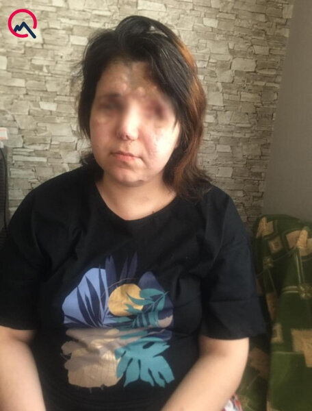 Gəncə terrorunda 2 gözünü itirən Pərvin... - FOTO