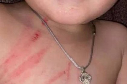 2 yaşlı uşaq bağçadan bu vəziyyətdə gəldi - FOTO