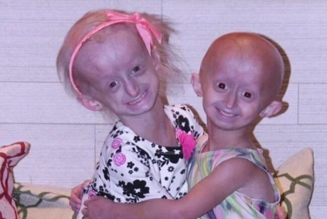 Uşaqlar sürətlə qocalır, ömrü qısalır - Progeriya xəstəliyi nədir?