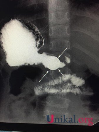 Bakıda 4 yaşlı uşağın mədəsində qəpik AŞKARLANDI