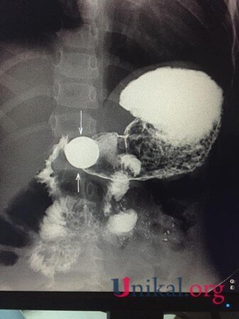 Bakıda 4 yaşlı uşağın mədəsində qəpik AŞKARLANDI