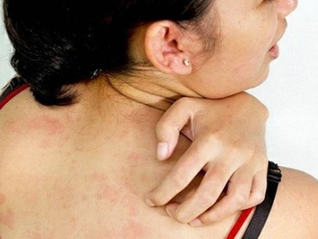 Kürəkdə səpgilər, qızartı və ləkələrin səbəbi