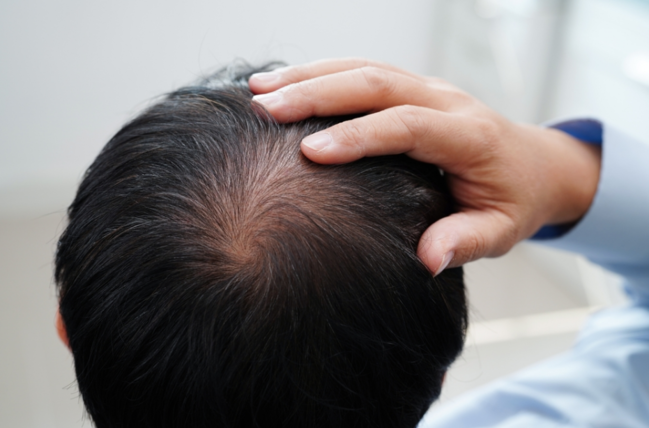 Saç Tökülməsi Ciddi Problemin Əlaməti Ola bilər - DERMATOLOQDAN AÇIQLAMA