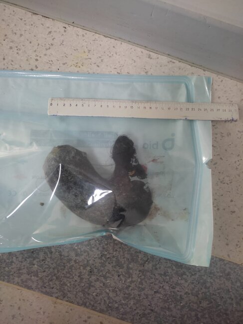 Ürəkbulanmadan şikayətlənirdi, mədəsindən saç kütləsi çıxarıldı - Foto